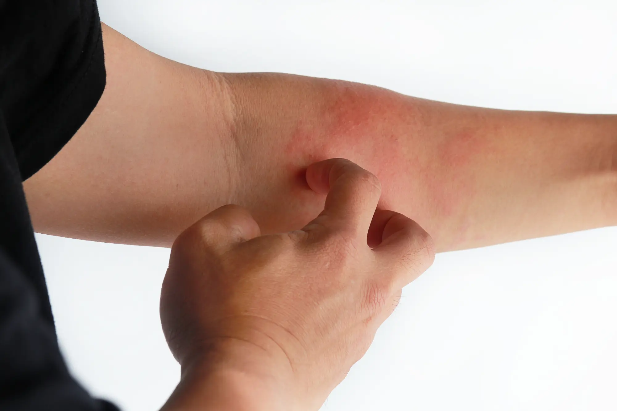 An example of dermatitis